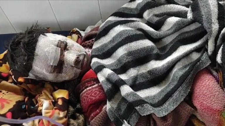 Jamshedpur News: पटाखा फोड़ने के क्रम में साकची का 8 वर्षीय आर्यन बुरी तरह झुलसा