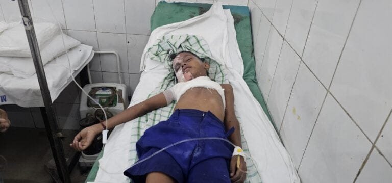 8 Years Old Burnt, Admitted In Mgm