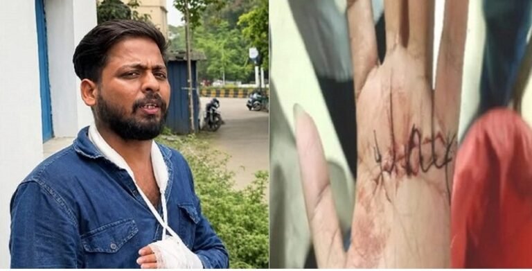 JAMSHEDPUR : गोलमुरी में युवक पर तलवार से जानलेवा हमला बचाव में कटा हाथ का पंजा पेट में भी गंभीर चोट